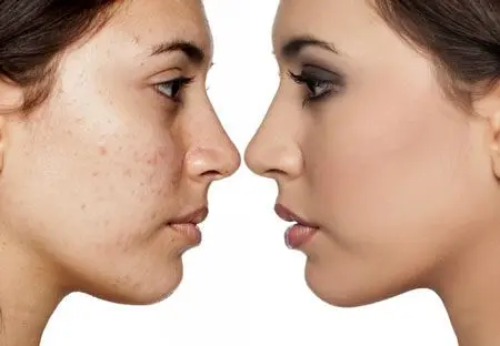 مراقبت های بعد از پانچ صورت