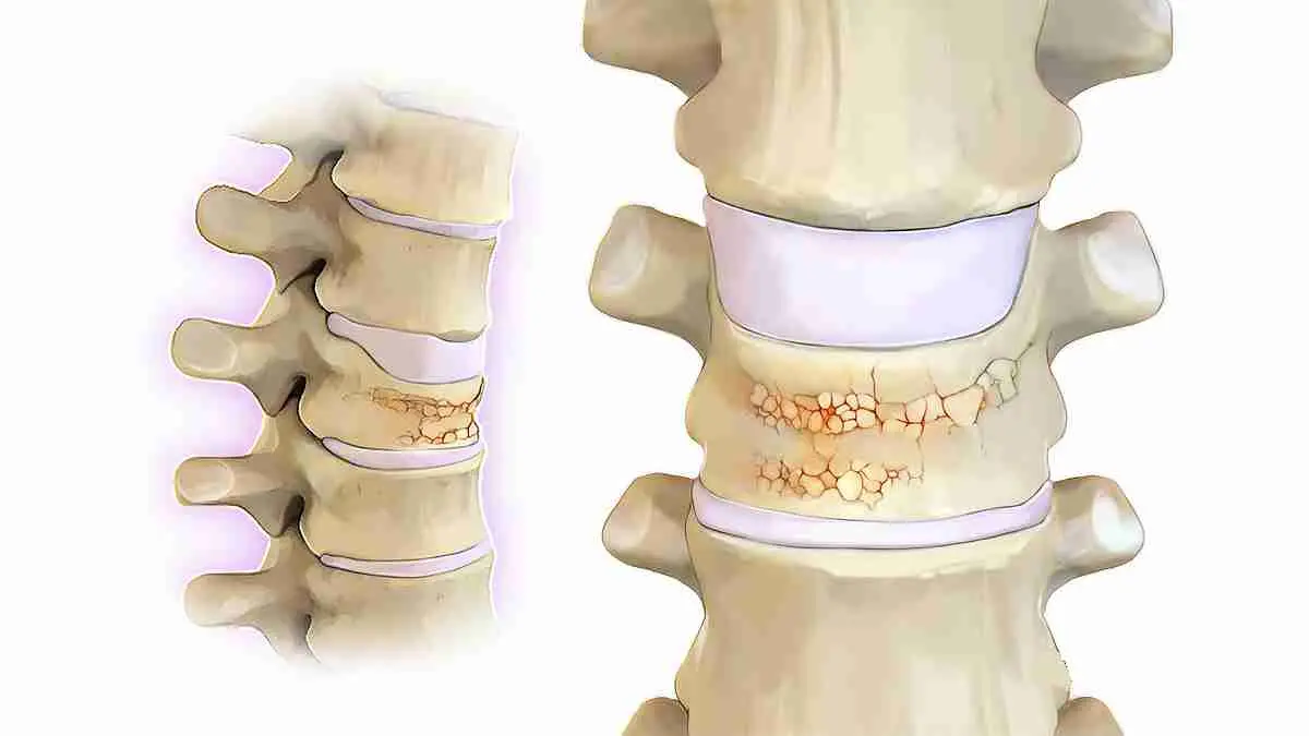 پیشگیری از پوکی استخوان در طب سنتی