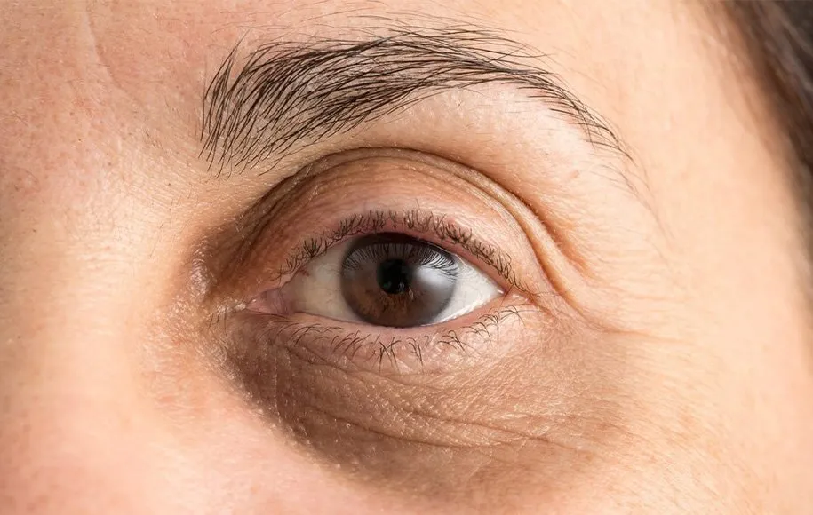 دلایل گودی زیر چشم کدامند؟