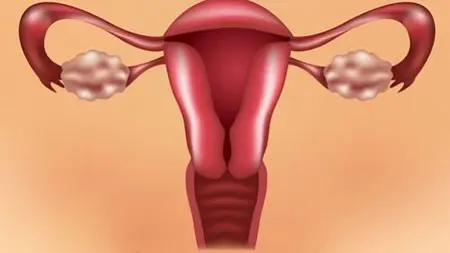 تنبلی تخمدان چیست؟