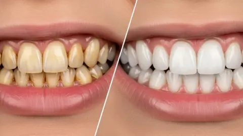 از بین بردن زردی دندان بر اثر سیگار